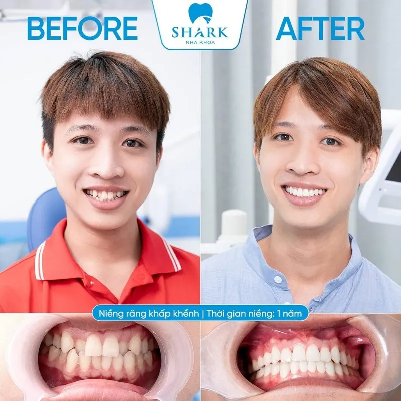 Răng trám có niềng được không? Cần lưu ý gì? 8 Kết quả niềng răng thành công của 1 khách hàng tại Nha Khoa Shark