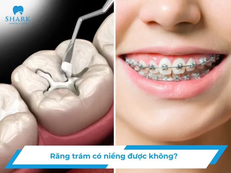Răng trám có niềng được không? Cần lưu ý gì?