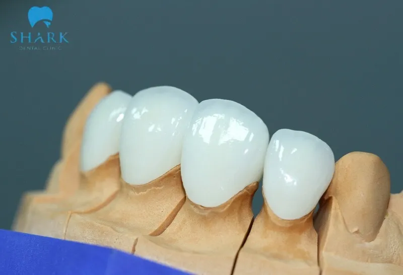 So sánh sứ kim loại và toàn sứ, nên chọn loại nào phù hợp? 8 Răng toàn sứ có độ thẩm mỹ cao, đem lại được khả năng ăn nhai tốt nhất