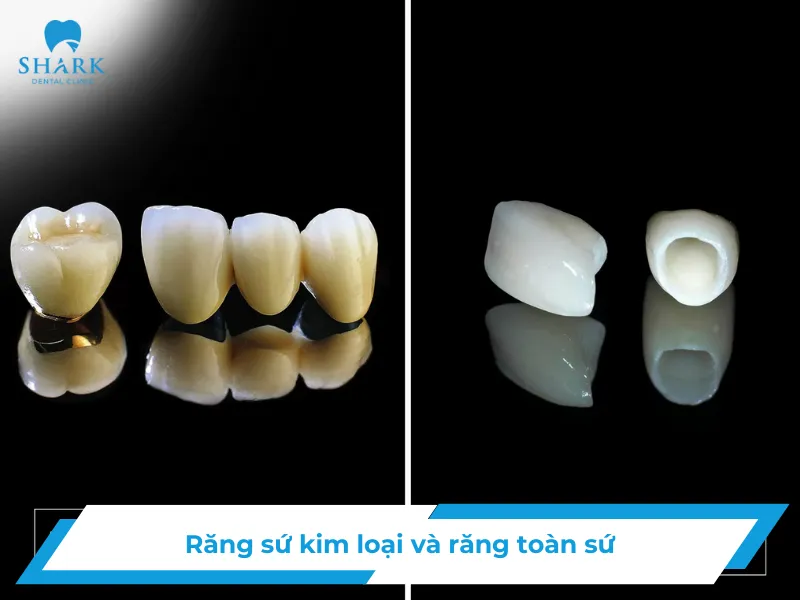 So sánh sứ kim loại và toàn sứ