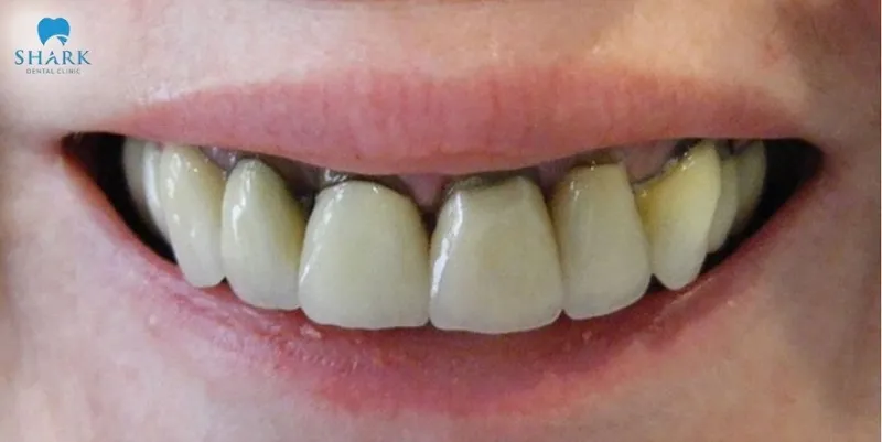 8 tác hại của răng sứ kim loại bạn nhất định phải biết 7 Răng sứ kim loại gây đen viền nướu sau 1 thời gian sử dụng, làm mất thẩm mỹ cho răng