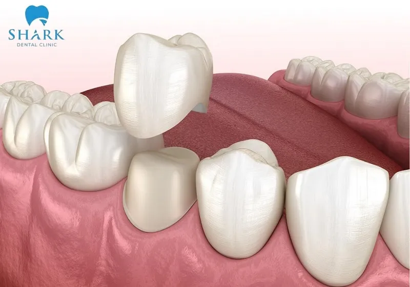 8 tác hại của răng sứ kim loại bạn nhất định phải biết 10 Việc bọc răng sứ không phù hợp theo các trường hợp chỉ định, có thể gây ra các tác hại không mong muốn