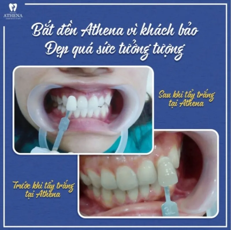 Nha khoa Athena đem đến khách hàng dịch vụ tẩy trắng răng công nghệ hiện đại giúp răng trắng sáng chỉ sau 1 liệu trình