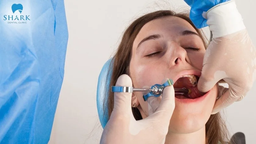 Thời gian thuốc tê nhổ răng phát huy tác dụng còn tùy thuộc vào từng loại thuốc khác nhau