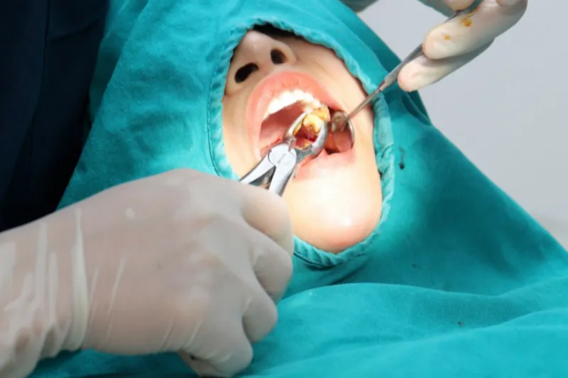 Bác sĩ tay nghề giỏi là yếu tố quan trọng trong ca nhổ răng khôn