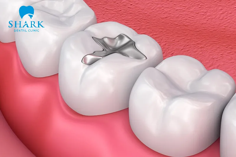 Trám răng Amalgam giá dao động từ 200.000 – 600.000đ/răng