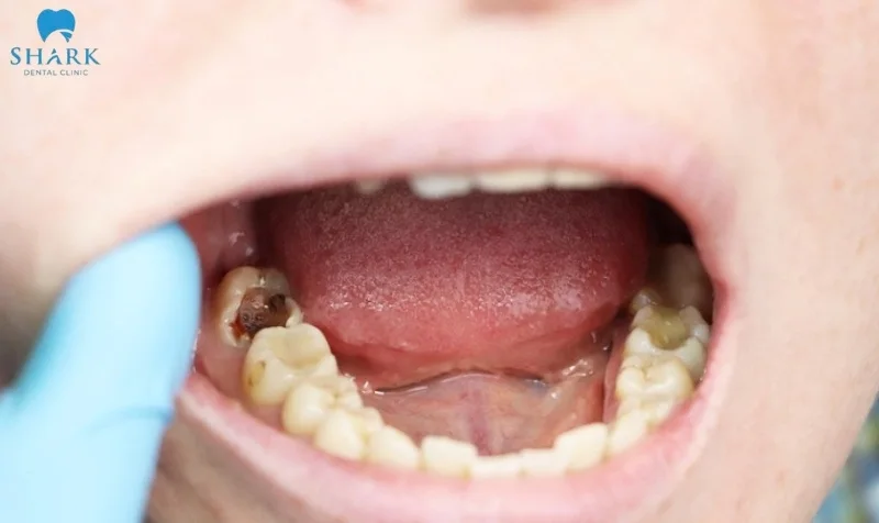 Trẻ bị sâu răng hàm có mọc lại không? Nguyên nhân vì sao? 9 Trẻ sâu răng hàm có mọc lại không?