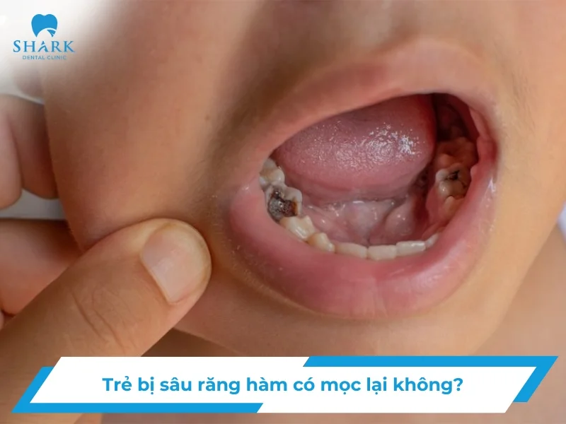 Trẻ bị sâu răng hàm có mọc lại không