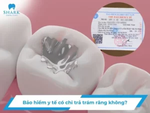 Bảo hiểm y tế có chi trả trám răng không?