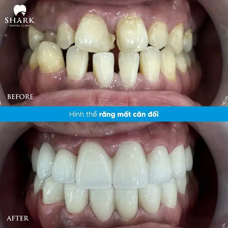 Bọc răng sứ thẩm mỹ là gì? Quy trình thực hiện như thế nào? 17 Bọc răng sứ cho răng mất cân đối