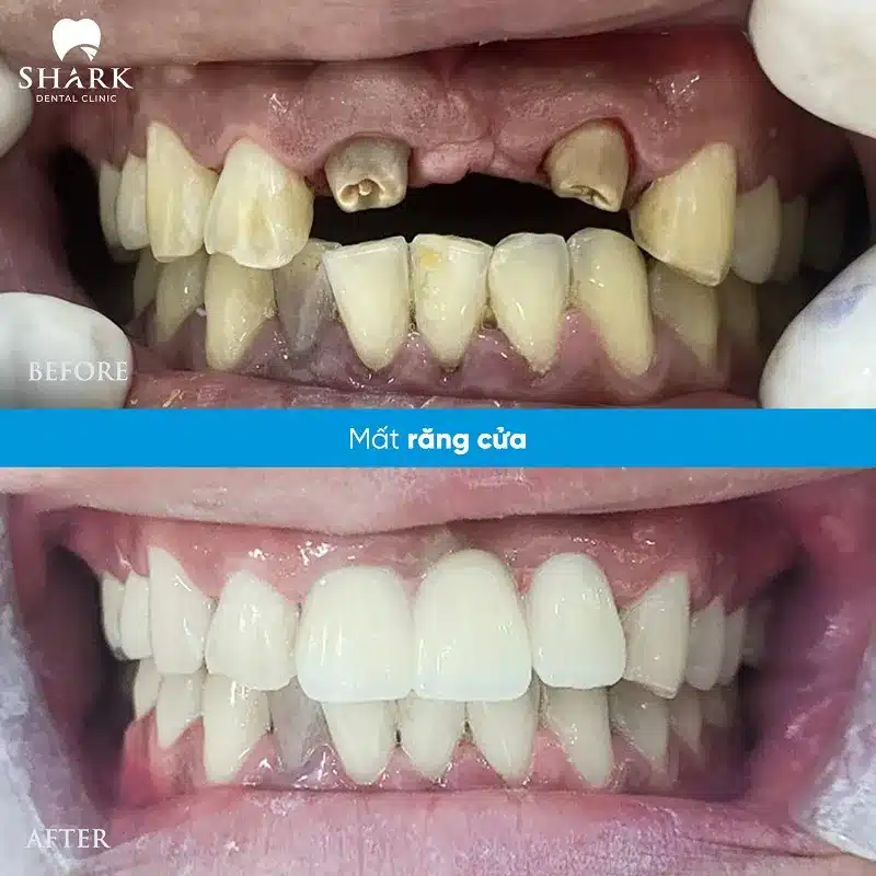 Bọc răng sứ thẩm mỹ là gì? Quy trình thực hiện như thế nào? 18 Mất răng cửa