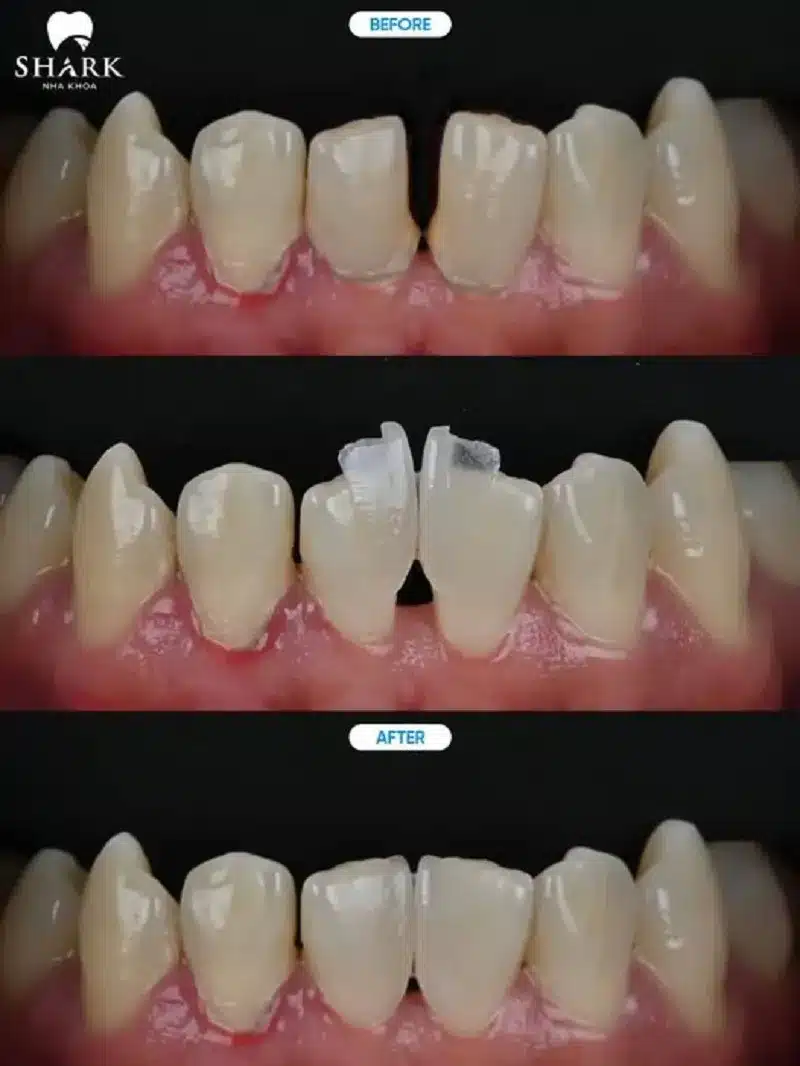 Có nên dán sứ Veneer không? Khi nào nên thực hiện? 16 Dán sứ siêu mỏng