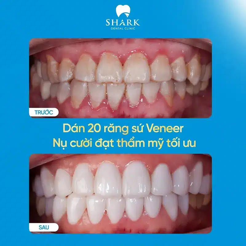 Có nên dán sứ Veneer không? Khi nào nên thực hiện? 17 Dán sứ cho 20 răng