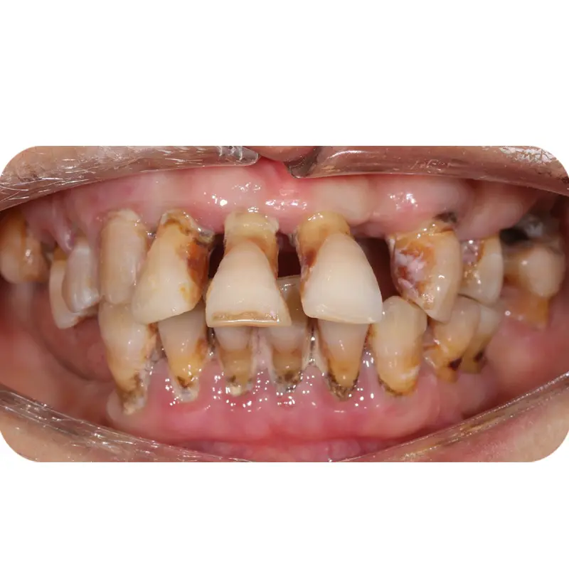 Ms Tuyet had full jaw implant 1