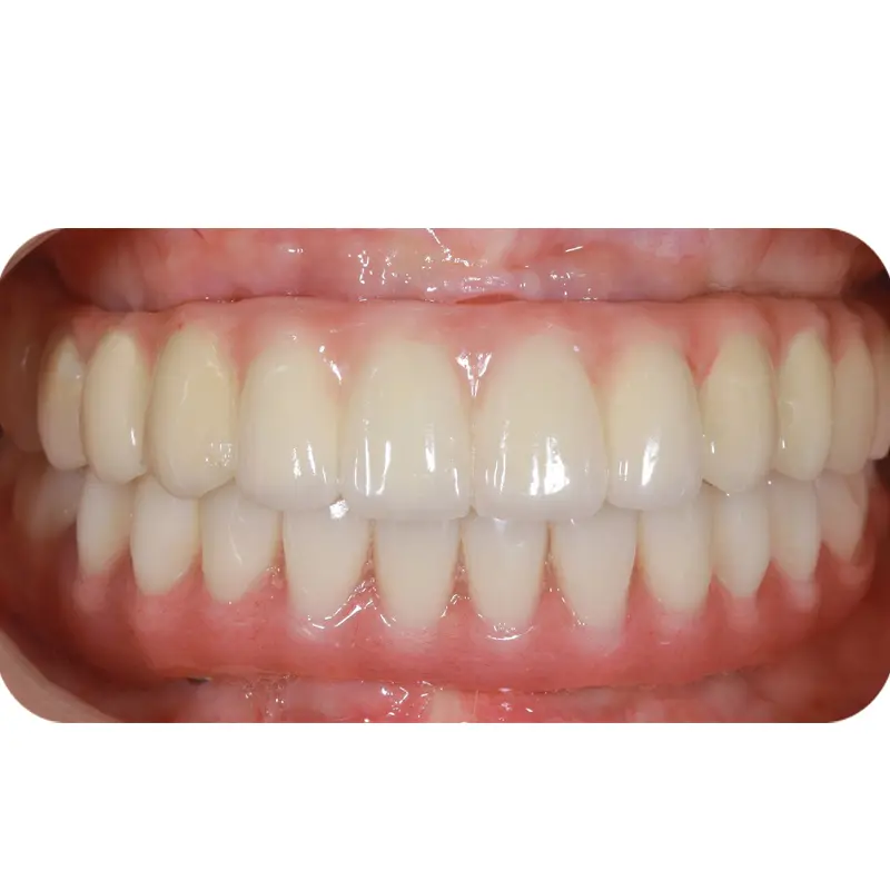Ms Tuyet had full jaw implant 2
