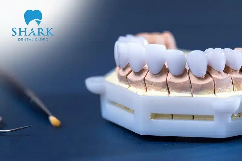 Răng sứ Vita được đánh giá cao về thẩm mỹ, áp dụng cho nhiều trường hợp