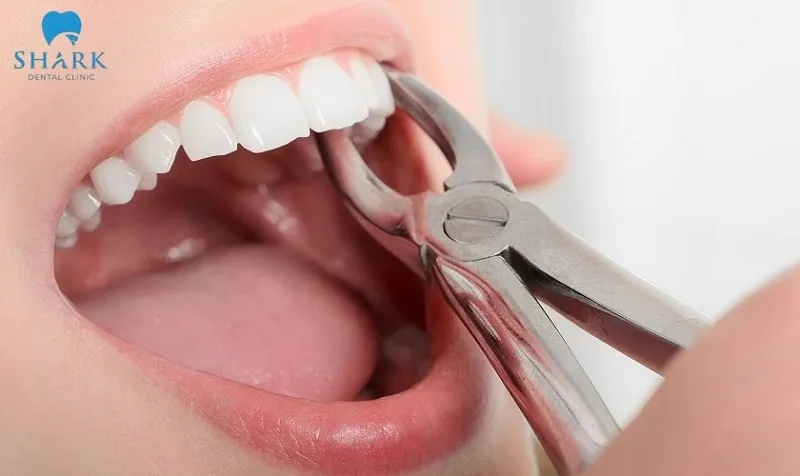 Những trường hợp nhổ răng do bệnh lý được bác sĩ chỉ định, sẽ được BHYT chi trả 