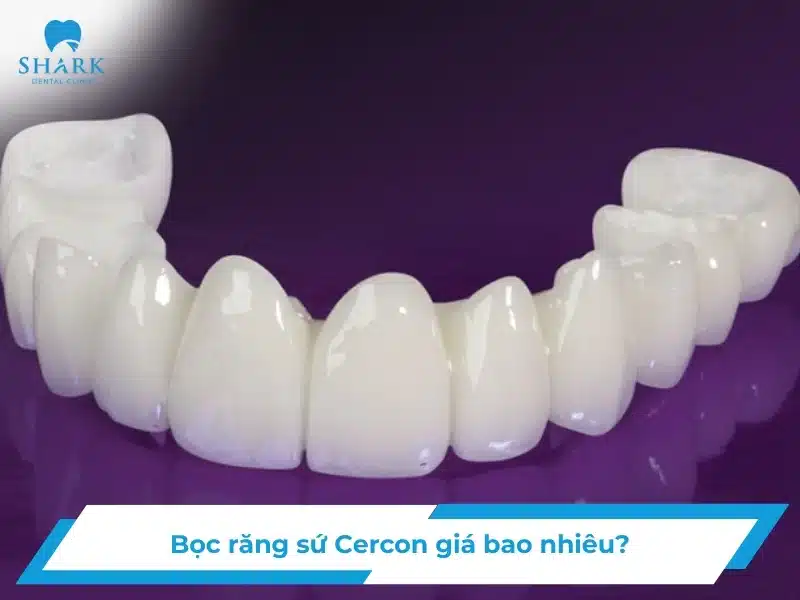 Bọc răng sứ Cercon giá bao nhiêu tiền