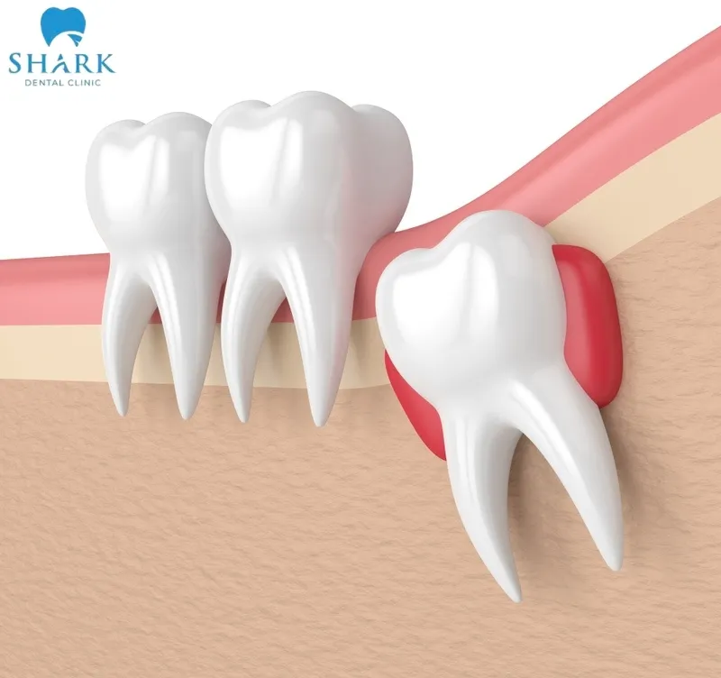 Do không đủ chỗ trống để phát triển, răng khôn thường có xu hướng mọc lệch sang một bên