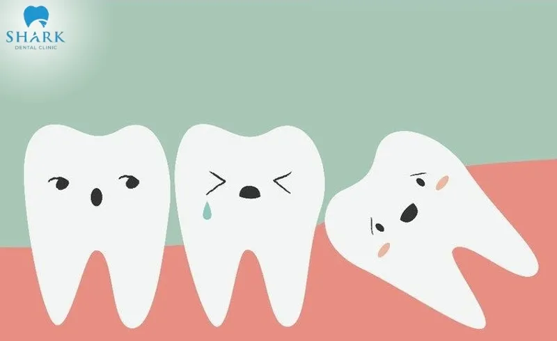 Răng khôn mọc lệch 45 độ là một trong các kiểu răng khôn mọc lệch phổ biến