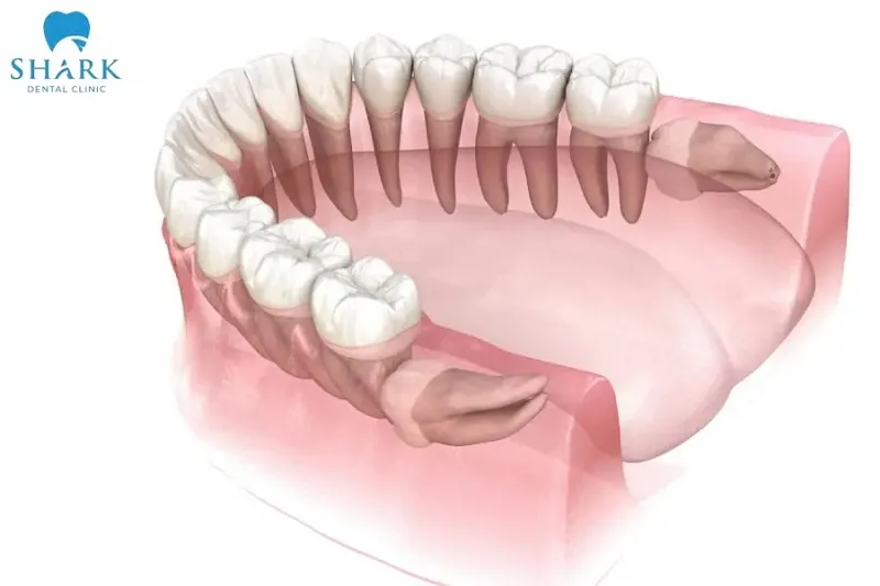 Trong các kiểu răng khôn mọc lệch, răng khôn mọc nằm ngang là kiểu mọc lệch gây đau đớn và nguy hiểm nhất