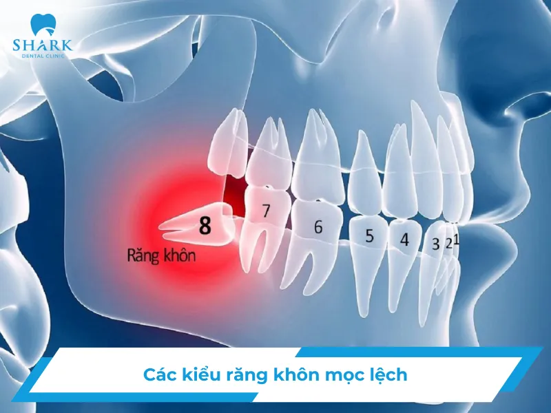 Các kiểu răng khôn mọc lệch phổ biến bạn cần biết