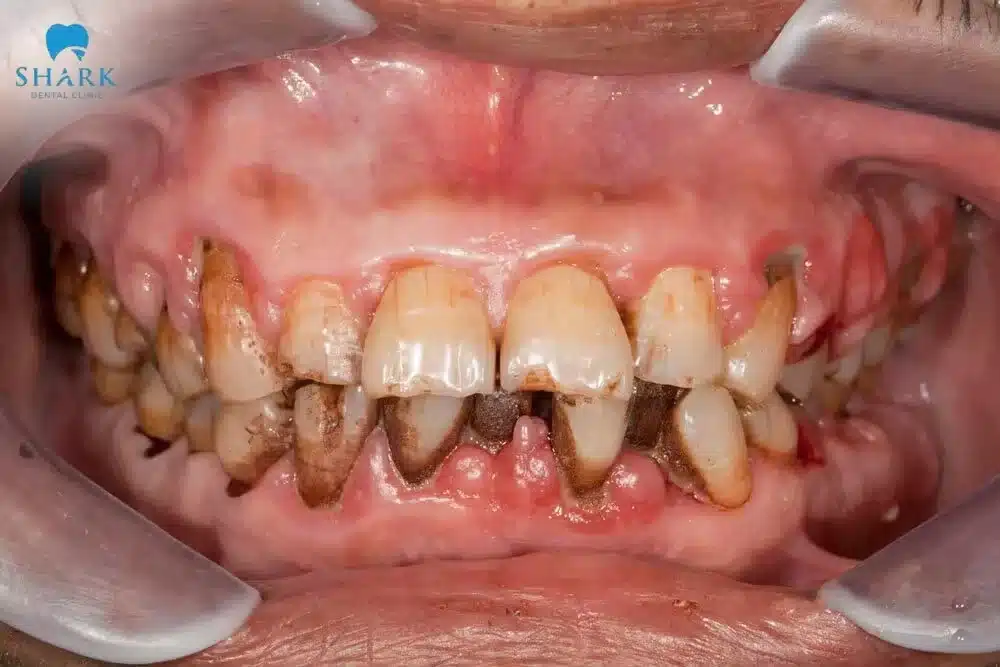 Cao răng bị đen ở chân răng gây mất thẩm mỹ