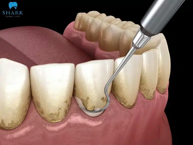 Không lấy cao răng thường xuyên sẽ làm cho mảng bám cao răng ngày càng dày và chuyển sang màu đen