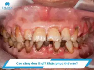 Cao răng đen