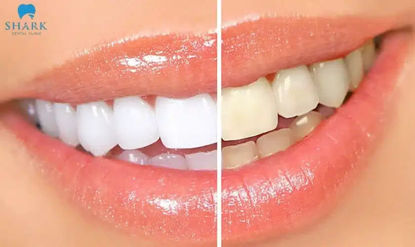 Lấy cao có làm trắng răng không?