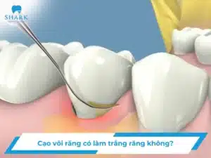 Cạo vôi răng có làm trắng răng không