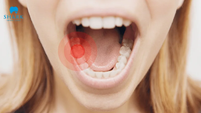 Cây cúc áo có tác dụng giảm đau răng tạm thời