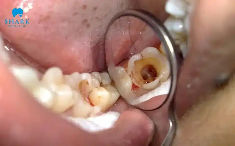Chữa tủy răng giá bao nhiêu tiền? Chi phí điều trị tủy 8/2025 8 Điều trị tủy răng hàm