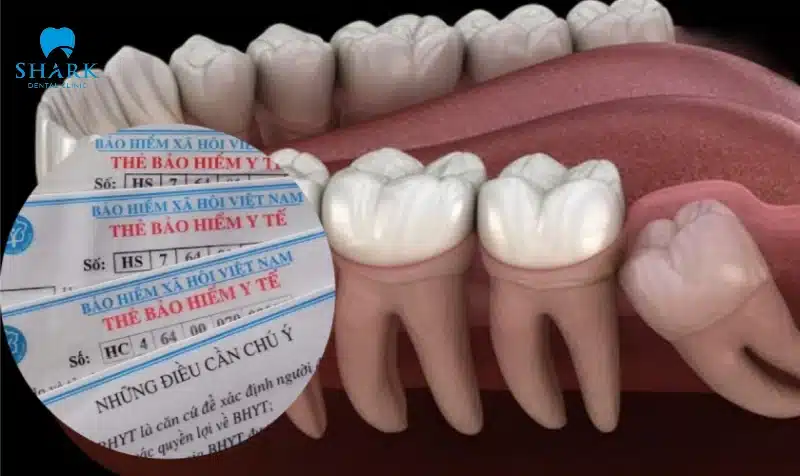 Chữa tủy răng giá bao nhiêu tiền? Chi phí điều trị tủy 8/2025 10 BHYT có chi trả cho việc điều trị tủy răng