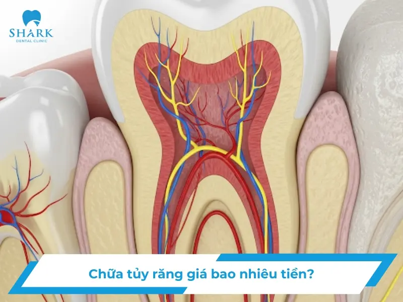 Chữa tủy răng giá bao nhiêu