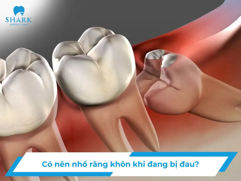 Có nên nhổ răng khôn khi đang bị đau không?