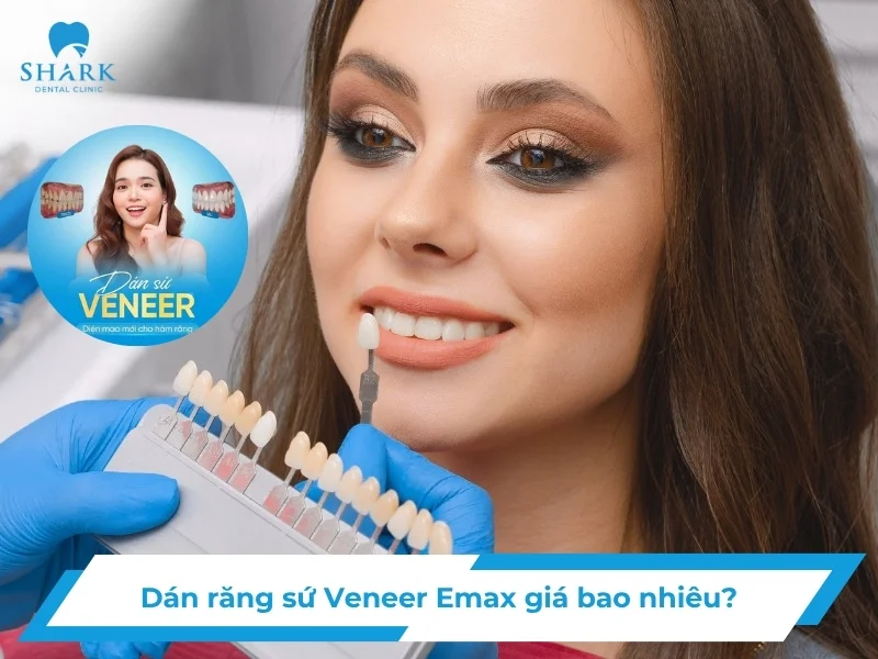 Dán răng sứ Veneer Emax bao nhiêu tiền