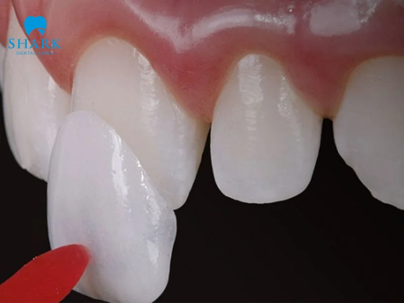 Mặt dán sứ Veneer được làm từ chất liệu cao cấp