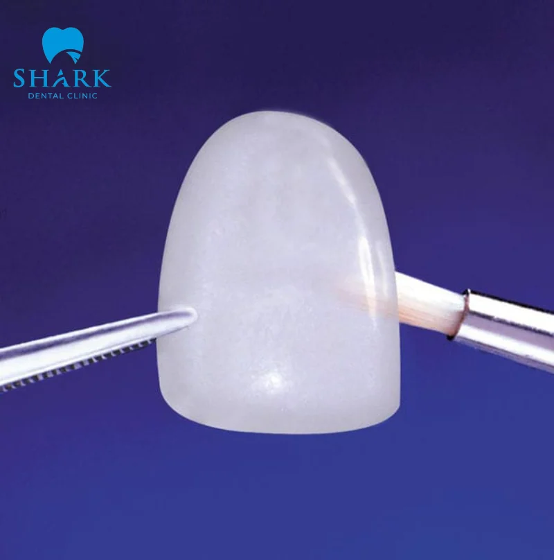 Miếng dán sứ Veneer Emax