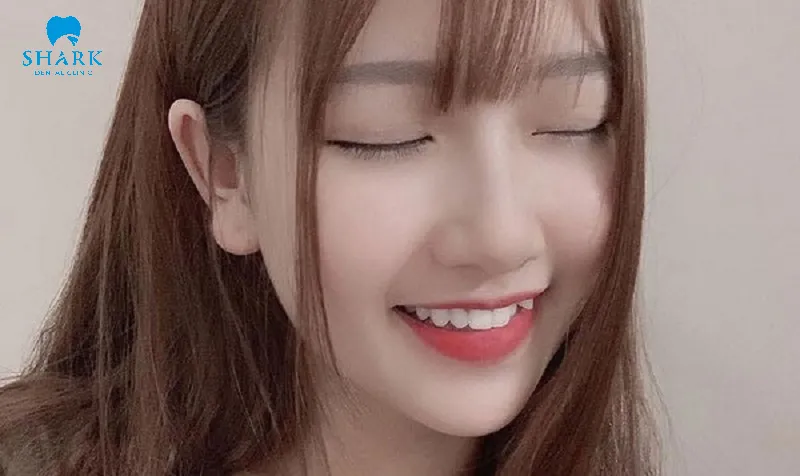 Đắp răng khểnh đẹp