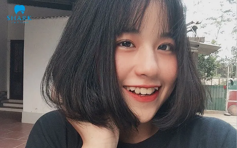 Đắp răng khểnh