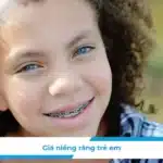 Giá niềng răng trẻ em