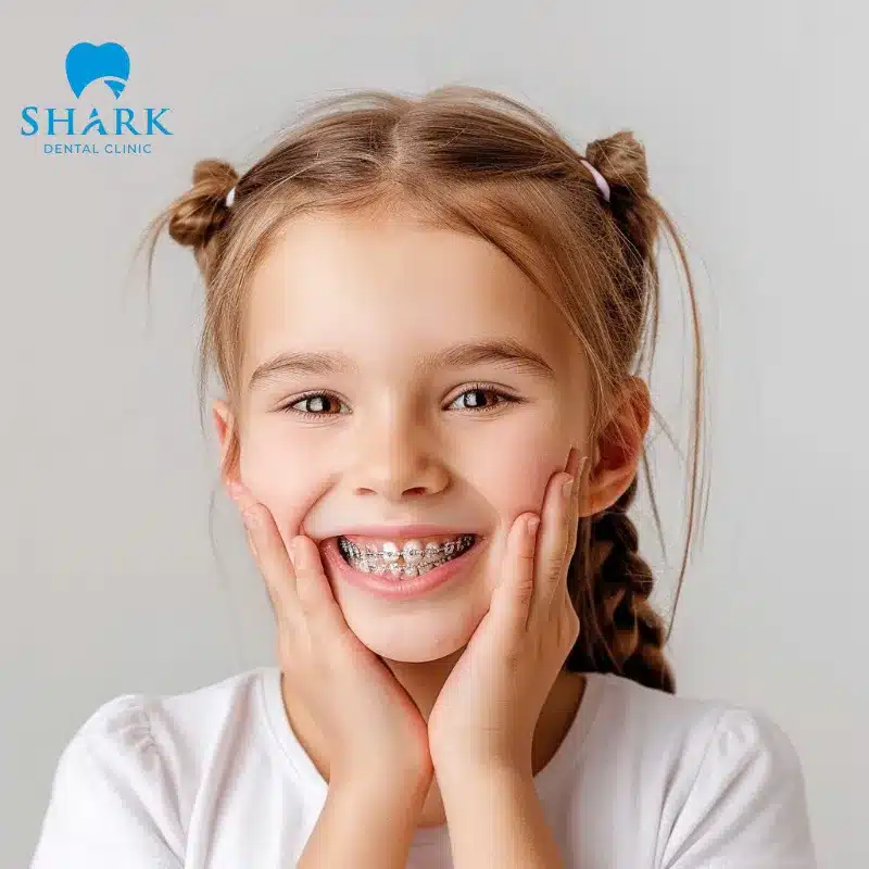 Niềng răng trẻ em giá bao nhiêu? Bảng giá mới 9/2025 10 Giai đoạn từ 6 - 12 tuổi là thời điểm vàng để trẻ chỉnh nha
