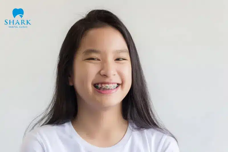 Niềng răng trẻ em giá bao nhiêu? Bảng giá mới 9/2025 16 Chọn nha khoa Shark để niềng răng cho bé là khoản đầu tư thông minh
