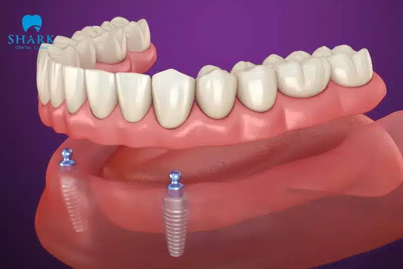 Hàm tháo lắp trên Implant giúp ổn định chức năng ăn nhai tốt