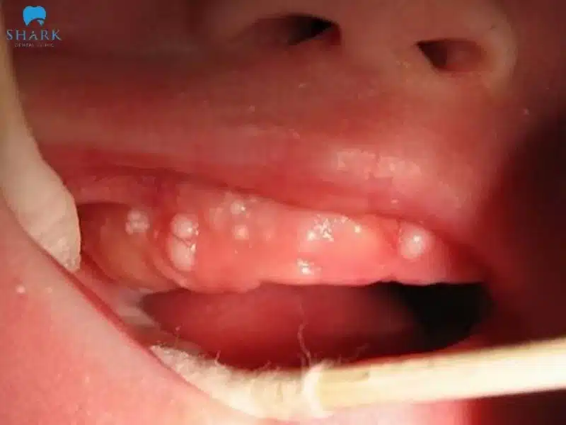 Nanh sữa ở trẻ là gì? Hình ảnh trẻ bị nanh sữa và cách xử lý 15 Nanh sữa là các đốm trắng trên vùng lợi của trẻ