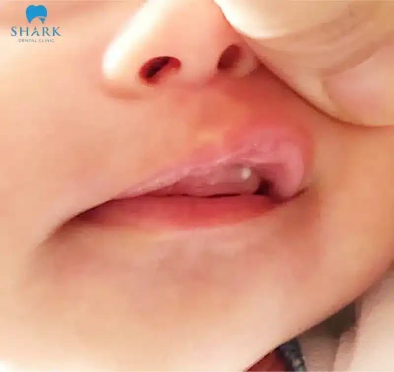 Nanh sữa ở trẻ là gì? Hình ảnh trẻ bị nanh sữa và cách xử lý 16 Hình ảnh trẻ mọc nanh sữa nhưng không quá nhiều