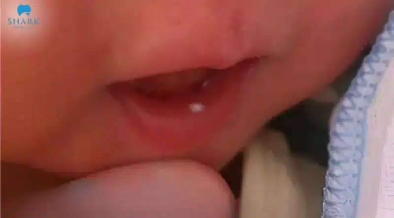 Nanh sữa ở trẻ là gì? Hình ảnh trẻ bị nanh sữa và cách xử lý 18 Trẻ sơ sinh mọc nanh sữa