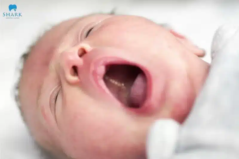 Nanh sữa ở trẻ là gì? Hình ảnh trẻ bị nanh sữa và cách xử lý 19 Hình ảnh nanh sữa ở vùng vòm họng