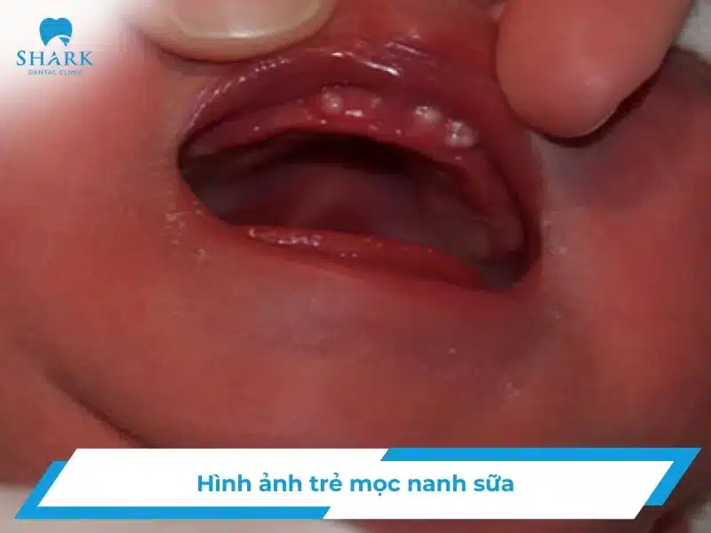 Hình ảnh trẻ bị nanh sữa